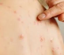 Segundo caso de sarampión confirmado en Montevideo; tuvo contacto con el chofer de Cutcsa